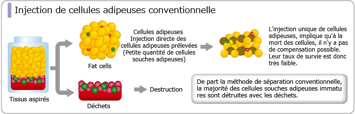 Injection de cellules adipeuses conventionnelle