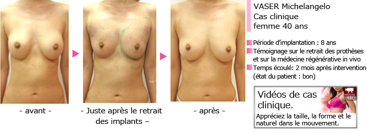 VASER Michelangelo Cas clinique (femme 40 ans)