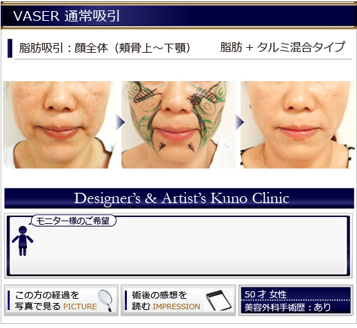VASER 通常吸引