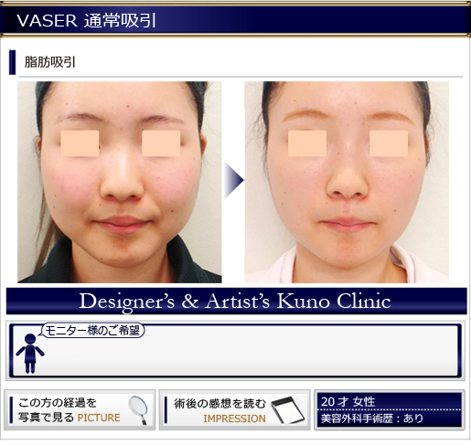 VASER 通常吸引