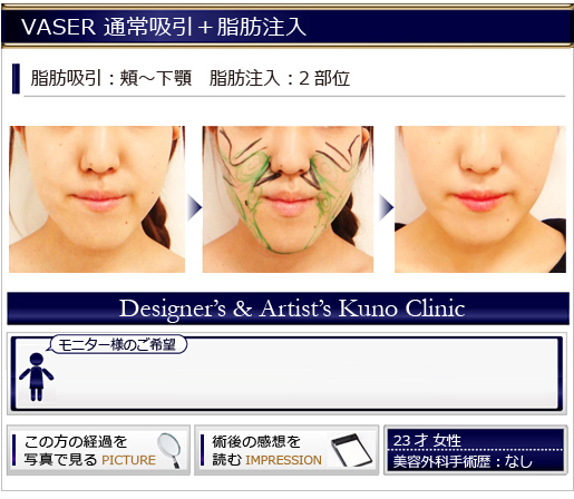 VASER 通常吸引