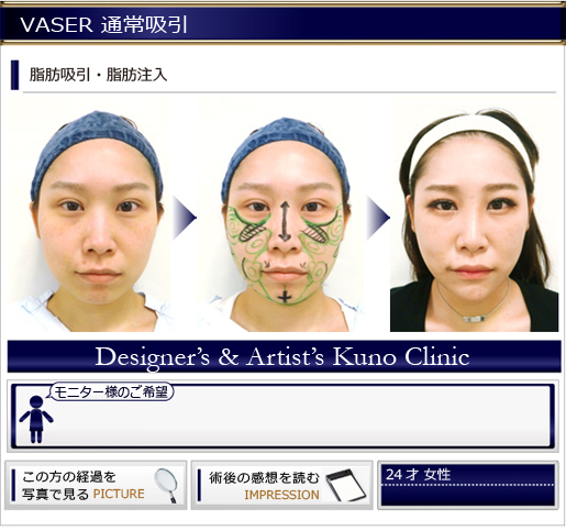 VASER 通常吸引