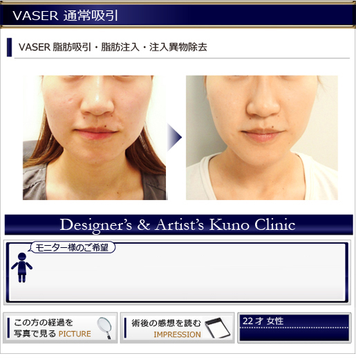 VASER 通常吸引