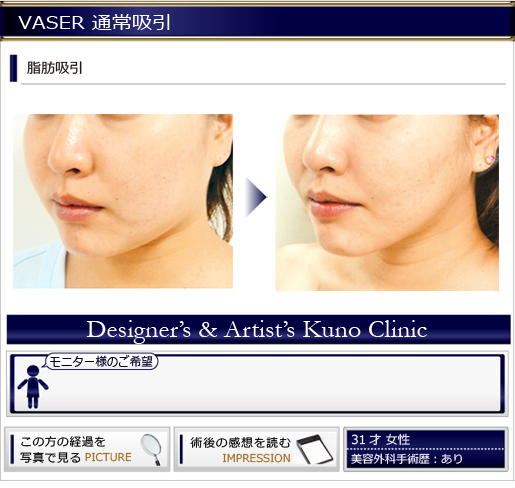 VASER 通常吸引