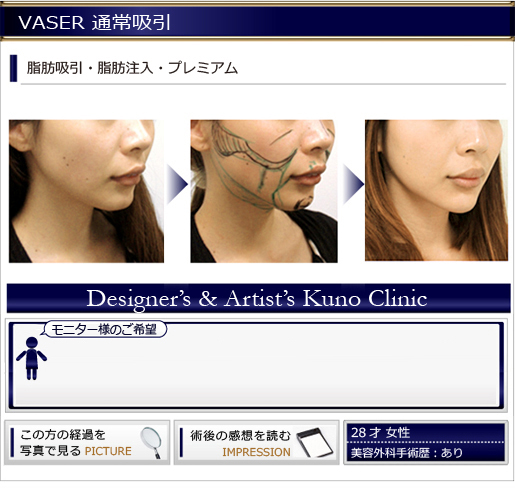 VASER 通常吸引