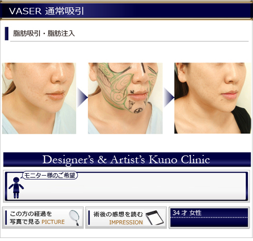 VASER 通常吸引