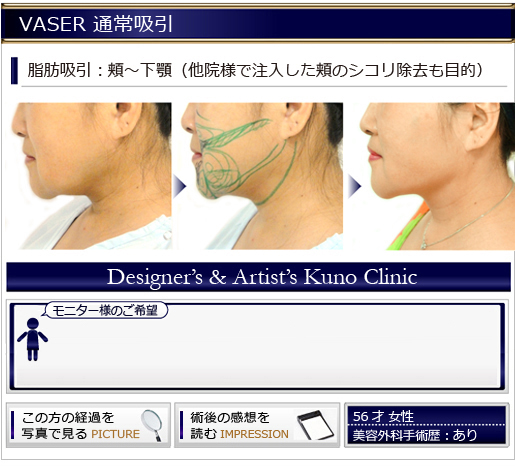VASER 通常吸引