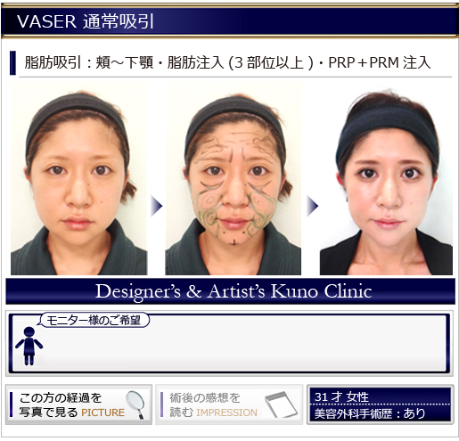 VASER 通常吸引
