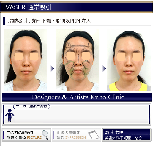 VASER 通常吸引