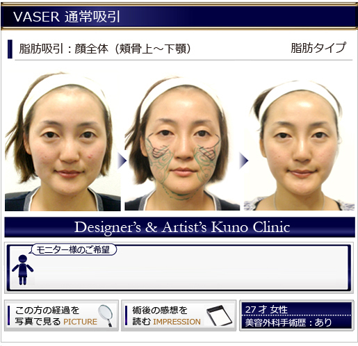 VASER 通常吸引