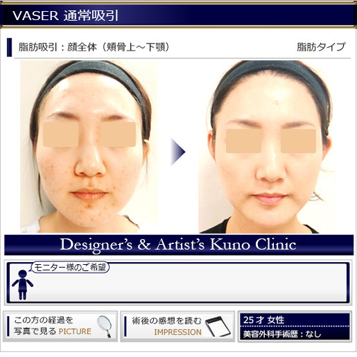 VASER 通常吸引