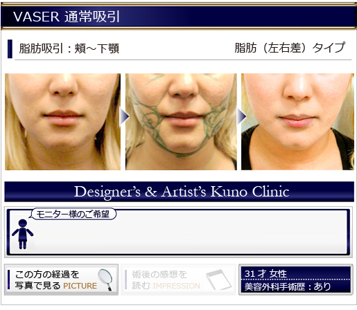 VASER 通常吸引