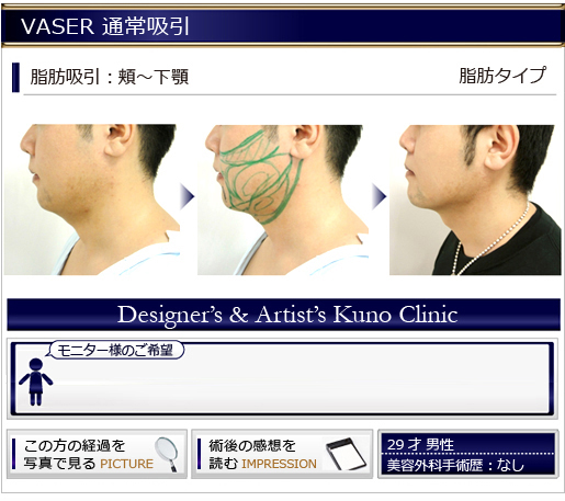 VASER 通常吸引