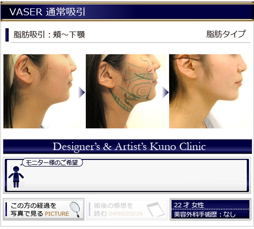 VASER 通常吸引