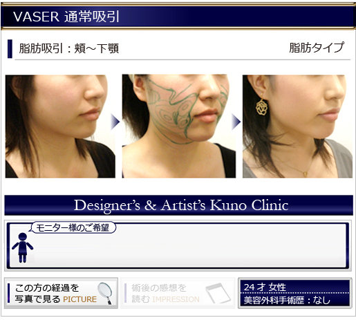 VASER 通常吸引