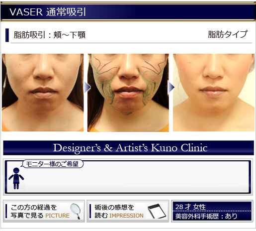 VASER1.0 クラシック通常吸引