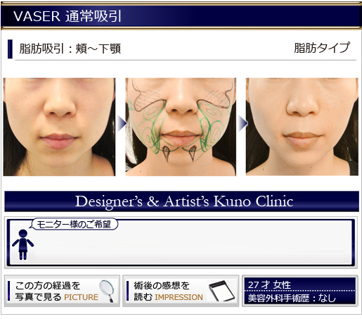 VASER 通常吸引