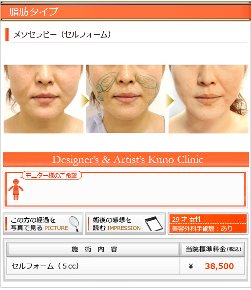 脂肪タイプ