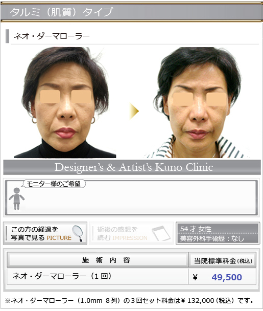 タルミ(肌質)タイプ