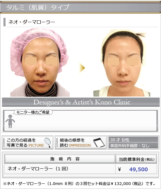 タルミ(肌質)タイプ