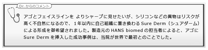 アゴとフェイスラインをよりシャープに見せたいが、シリコンなどの異物はリスクが高く不自然になるので、1年以内に自己組織に置き換わるSure Derm（シュアダーム）による形成を御希望されました。製造元のHANS biomedの担当者によると、アゴにSure Dermを挿入した成功事例は、当院が世界で最初とのことでした。