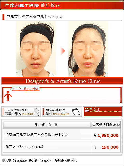 頬の陥没を改善 生体内再生医療