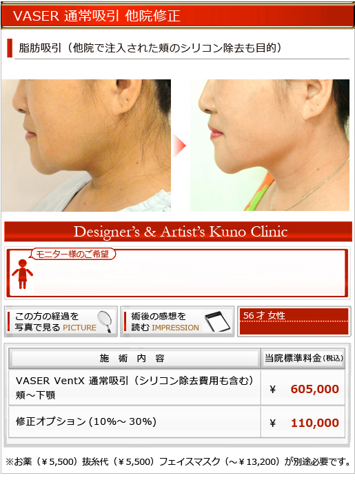 脂肪吸引(他院で注入された頬のシリコン除去も目的)