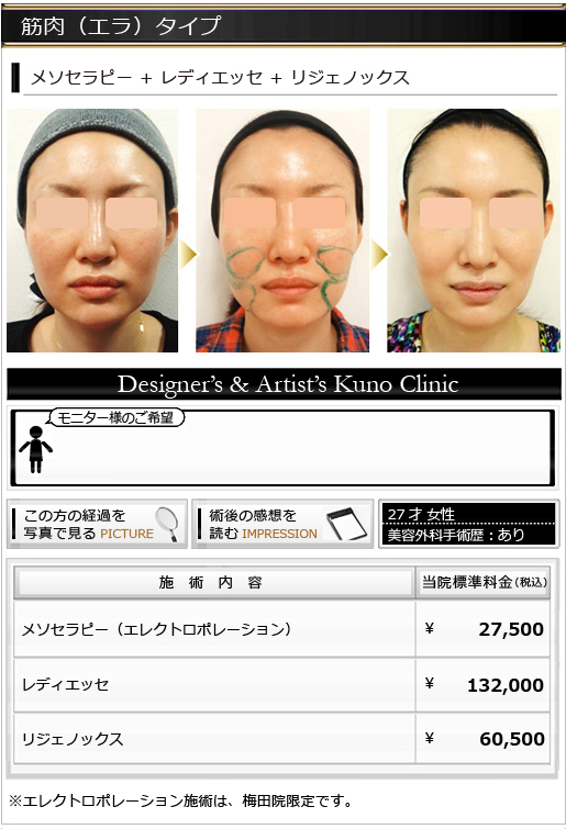 タルミタイプ